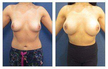 Breast Augmentation Surgeon Results