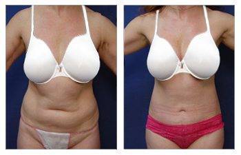 Mini Tummy Tuck — #SS068