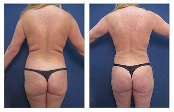 Back Liposuction + BBL — #SS042