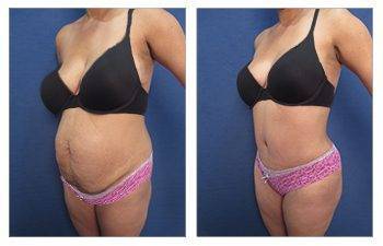 HD Liposuction — #SS038