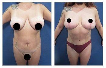 360 Liposuction