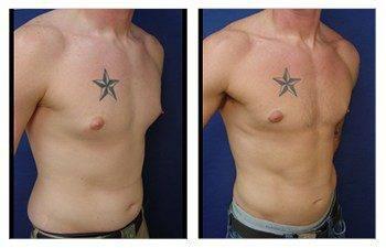 Gynecomastia — #SS208