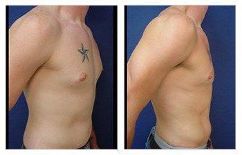Gynecomastia — #SS208
