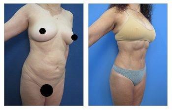 Before and after photos of a tummy tuck procedure with advanced liposuction.