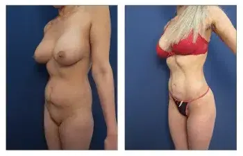 Advances in High Definition Liposuction