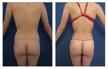 SurgiSculpt