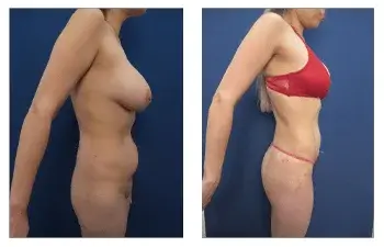 SurgiSculpt
