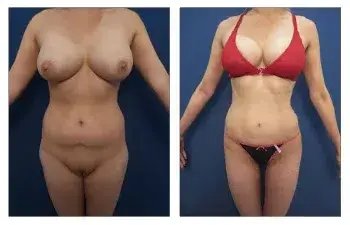 Advances in High Definition Liposuction