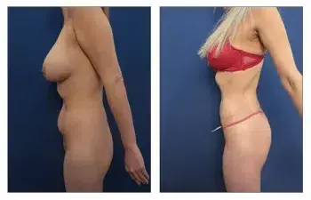 Advances in High Definition Liposuction