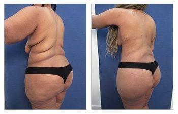 Arm Lift Scar — photo 4 | SurgiSculpt®