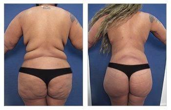 Arm Lift Scar — photo 5 | SurgiSculpt®