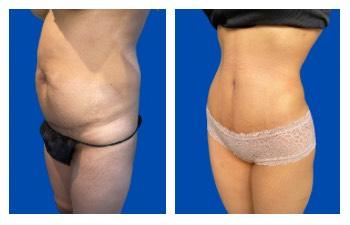 Awake Liposuction Cost results — photo 2 | SurgiSculpt®