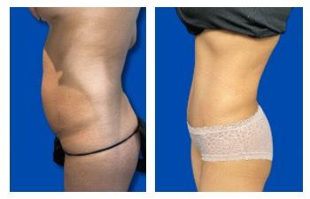 Awake Liposuction Cost results — side view — photo 3 | SurgiSculpt®
