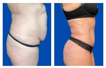 Awake Liposuction Los Angeles results — side view — photo 3 | SurgiSculpt®