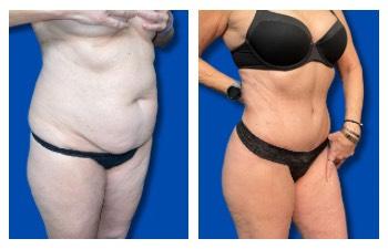 Awake Liposuction Los Angeles results — photo 2 | SurgiSculpt®