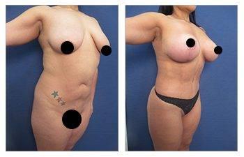 Before and after photos of a tummy tuck procedure for High Definition Liposuction Revision.