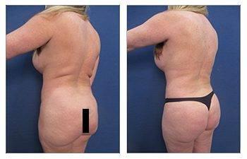 Back Liposuction