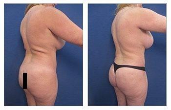 Back Liposuction