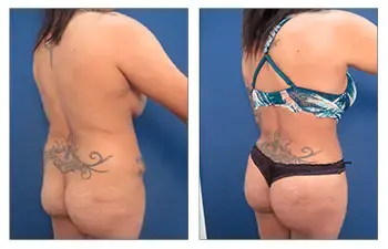 BBL Plastic Surgery