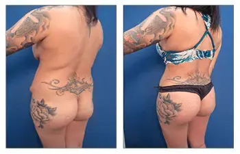 BBL Plastic Surgery