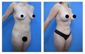 awake liposuction