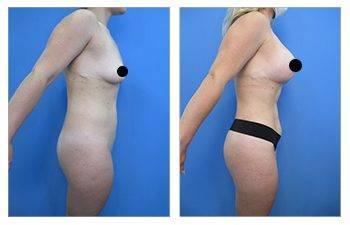 awake liposuction