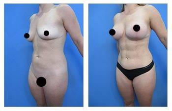 Benefits of Awake Liposuction — photo 3 | SurgiSculpt®