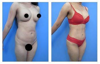 Benefits of VASER Liposuction