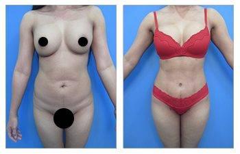 Benefits of VASER Liposuction