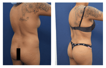 Best Brazilian Butt Lift or BBL Revision Doctors