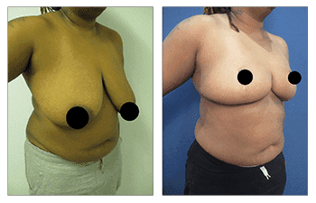 Stunning before and after pictures showcasing the remarkable results of the best breast reduction surgery.