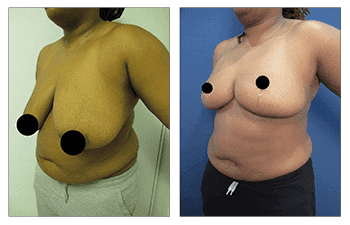 Best before and after pictures of a woman's breast reduction surgery.