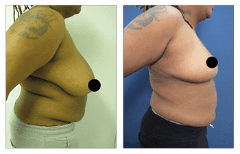Get a glimpse of the incredible transformation with our best tummy tuck before and after results.
