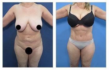 Best Liposuction for plus sized clients