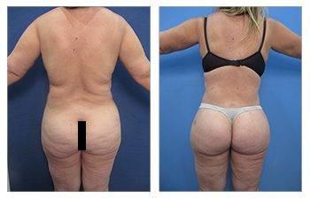 Liposuction for plus sized clients