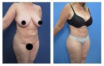 Liposuction for plus sized clients