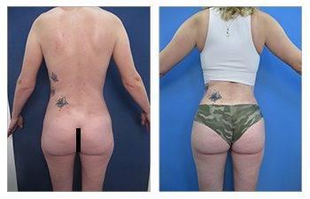 Tummy tuck before and after with Safe BBL Protocol.
