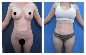 Best Liposuction Surgeon in Los Angeles — patient photo