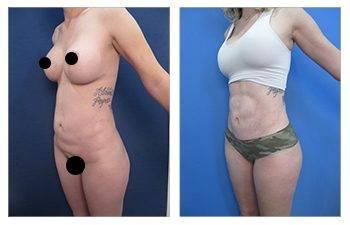 Best Liposuction Surgeon in Los Angeles — patient photo