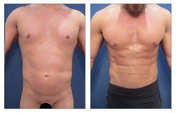 Best Male Abdominal Etching Results