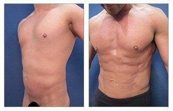 Best Male Abdominal Etching Results