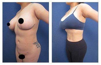 Beware of Yelp for choosing your plastic surgeon — photo 1 | SurgiSculpt®