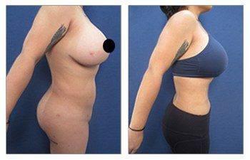 Beware of Yelp for choosing your plastic surgeon — photo 3 | SurgiSculpt®