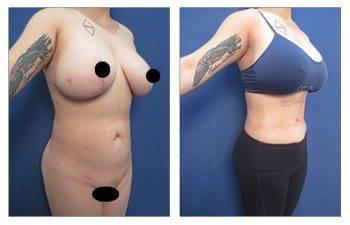 Beware of Yelp for choosing your plastic surgeon — photo 4 | SurgiSculpt®