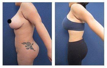 Beware of Yelp for choosing your plastic surgeon — photo 2 | SurgiSculpt®