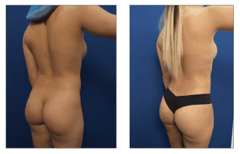Combining tummy tuck with Lipo - view incredible before and after results!