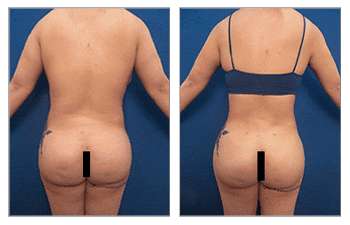 Before and after pictures of a woman's butt following a BBL redo.