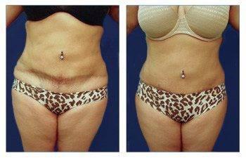 Mini tummy tuck for scar revision