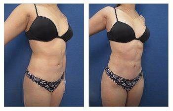 What Kind of Result will I Get After Mini Tummy Tuck? See before and after transformations.