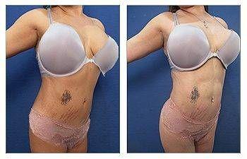 Mini Tummy Tuck — #SS155